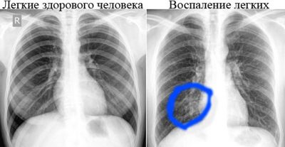 Рентген здоровых легких