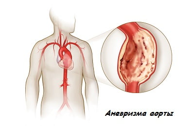 Аневризме аорты