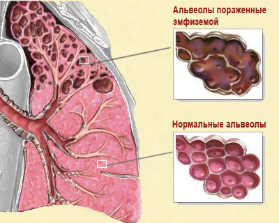 Эмфизема легких