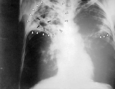 Цирротический туберкулез