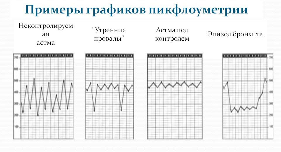 Примеры графиков пикфлоуметрии