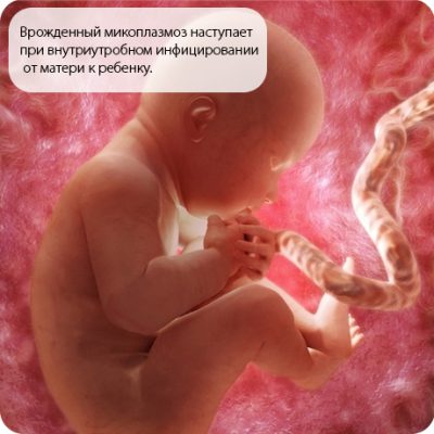 Микоплазмоз у ребенка