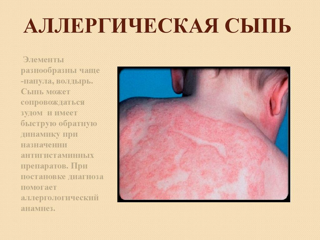 Аллергическая сыпь